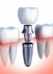 An image showing the main parts of a dental implant